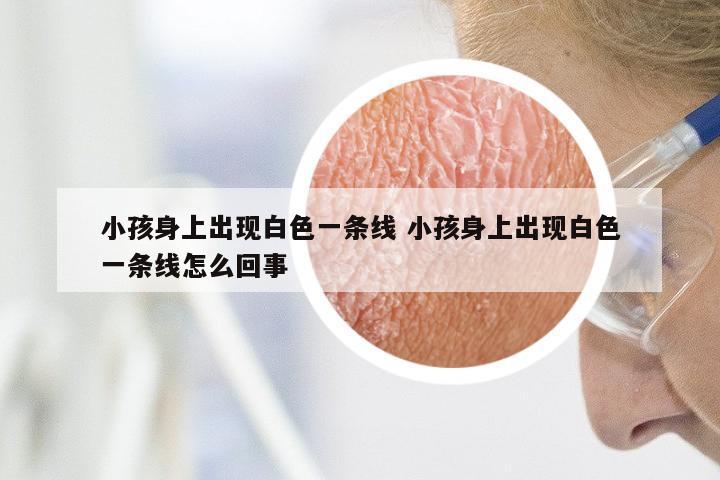 小孩身上出现白色一条线 小孩身上出现白色一条线怎么回事