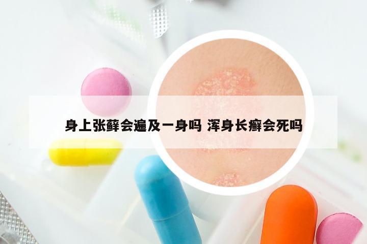 身上张藓会遍及一身吗 浑身长癣会死吗