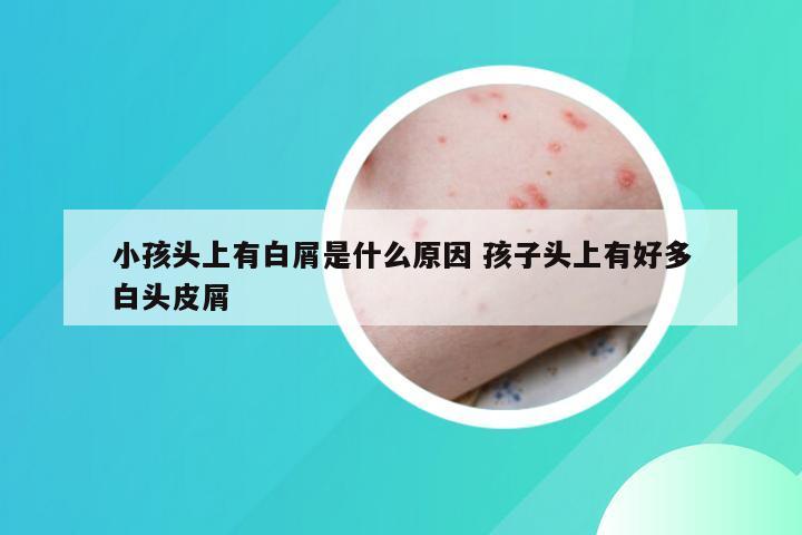 小孩头上有白屑是什么原因 孩子头上有好多白头皮屑