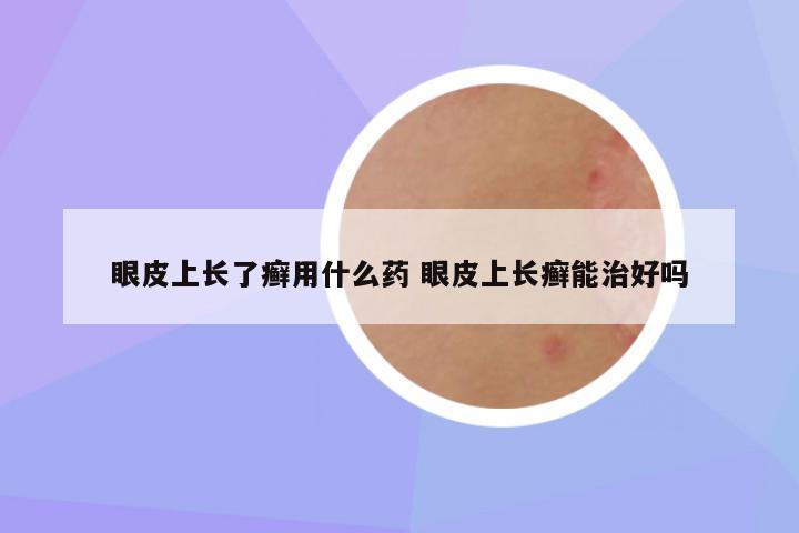 眼皮上长了癣用什么药 眼皮上长癣能治好吗