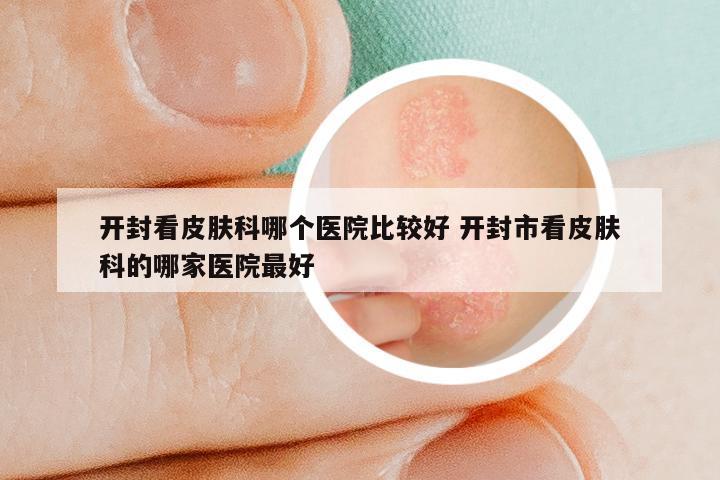 开封看皮肤科哪个医院比较好 开封市看皮肤科的哪家医院最好