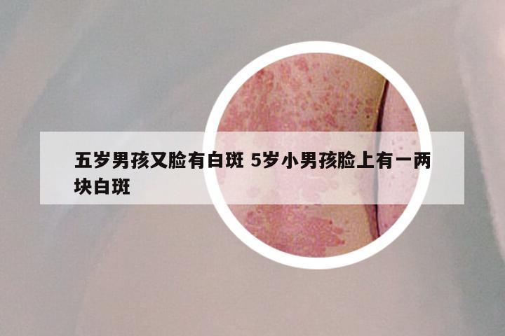 五岁男孩又脸有白斑 5岁小男孩脸上有一两块白斑