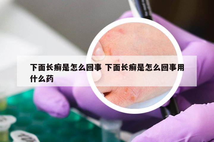 下面长癣是怎么回事 下面长癣是怎么回事用什么药