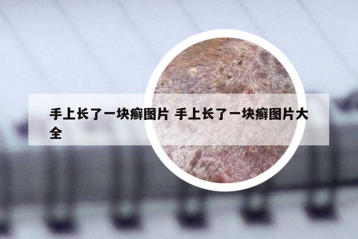 手上长了一块癣图片 手上长了一块癣图片大全