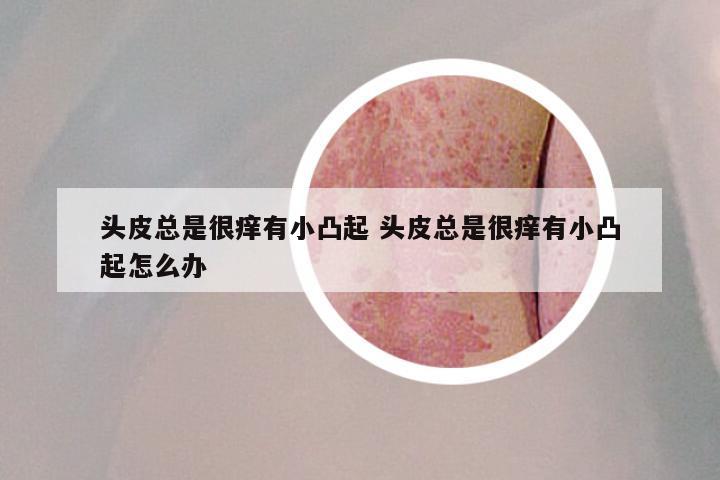 头皮总是很痒有小凸起 头皮总是很痒有小凸起怎么办