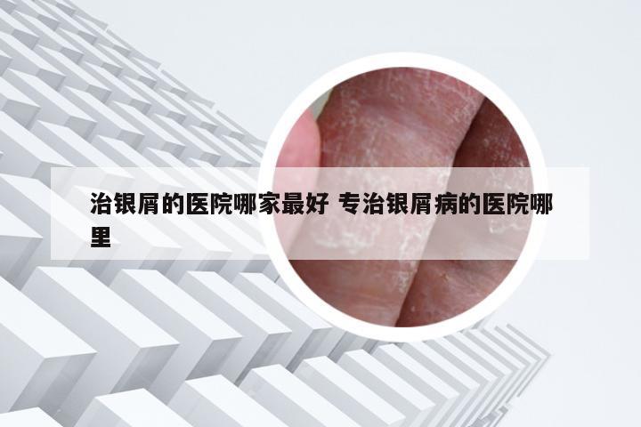 治银屑的医院哪家最好 专治银屑病的医院哪里