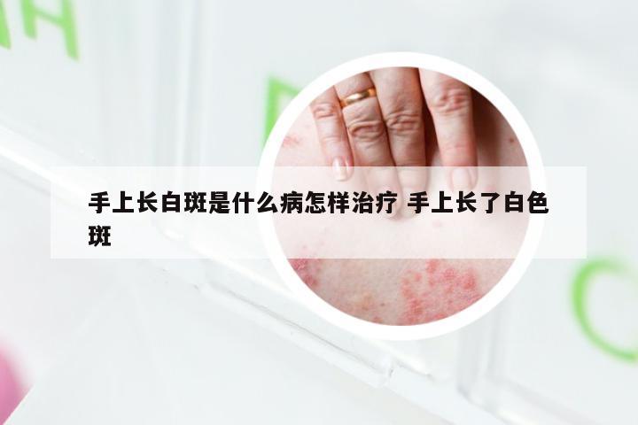 手上长白斑是什么病怎样治疗 手上长了白色斑