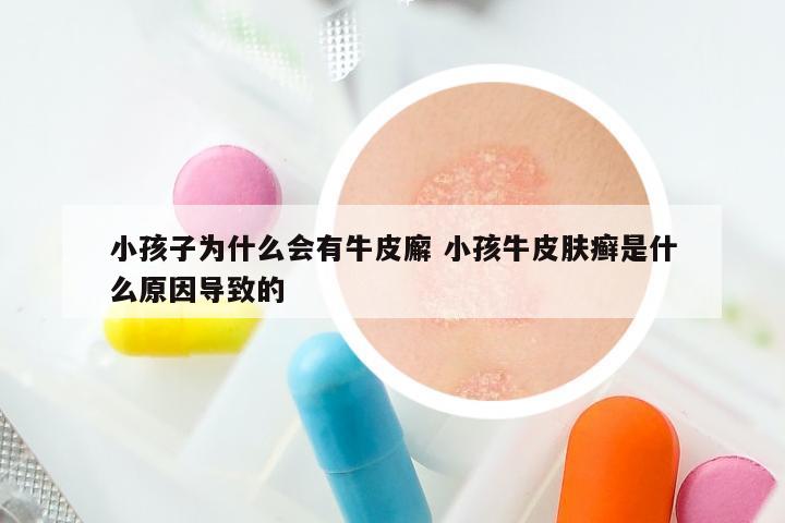 小孩子为什么会有牛皮廨 小孩牛皮肤癣是什么原因导致的