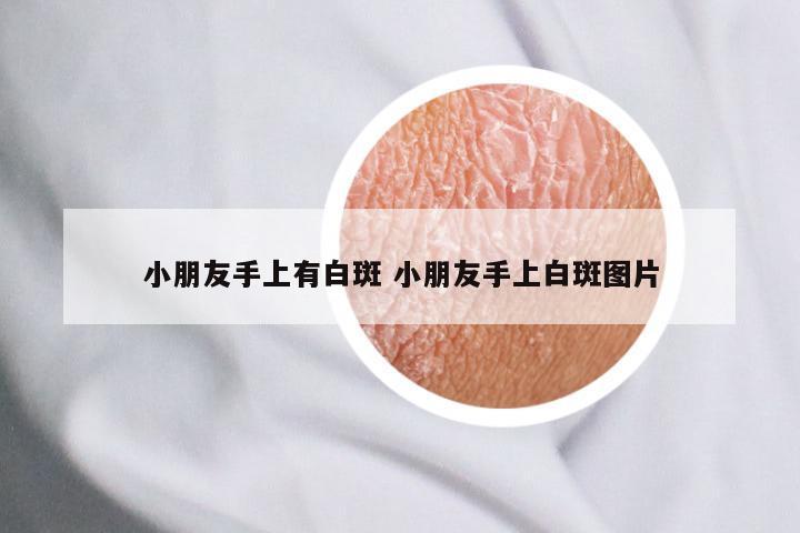 小朋友手上有白斑 小朋友手上白斑图片