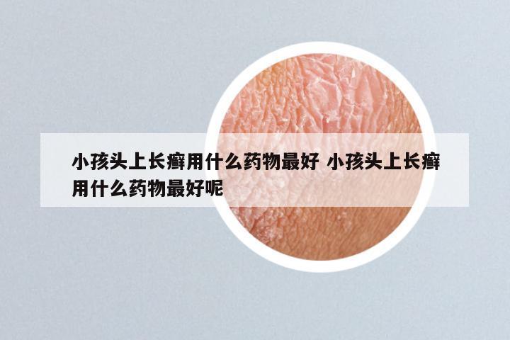 小孩头上长癣用什么药物最好 小孩头上长癣用什么药物最好呢