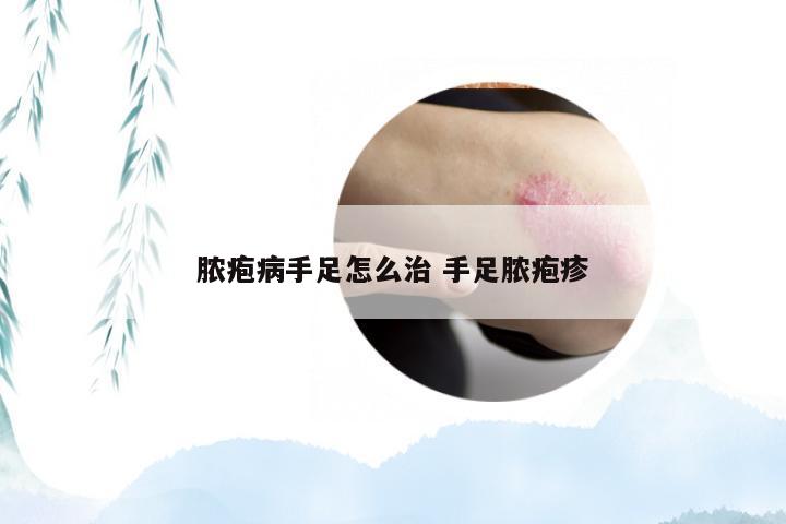 脓疱病手足怎么治 手足脓疱疹