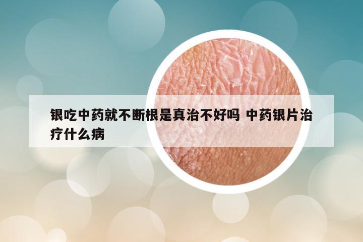 银吃中药就不断根是真治不好吗 中药银片治疗什么病