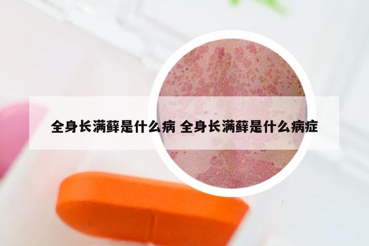全身长满藓是什么病 全身长满藓是什么病症