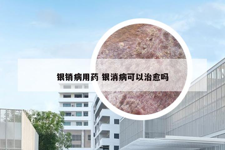 银销病用药 银消病可以治愈吗