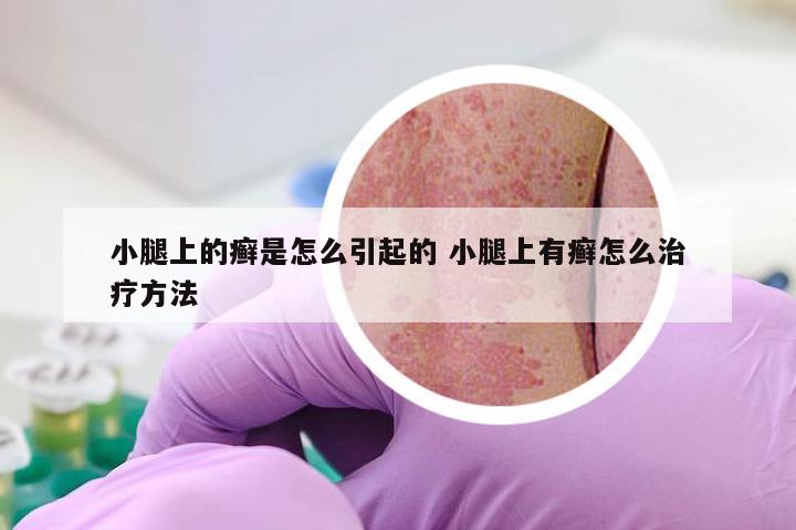小腿上的癣是怎么引起的 小腿上有癣怎么治疗方法