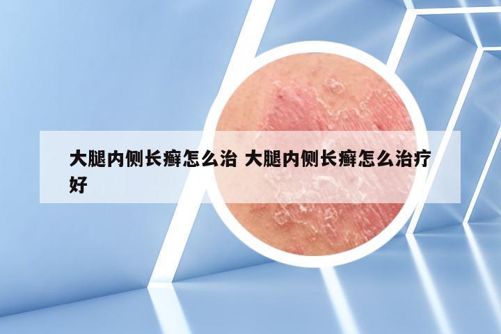 大腿内侧长癣怎么治 大腿内侧长癣怎么治疗好