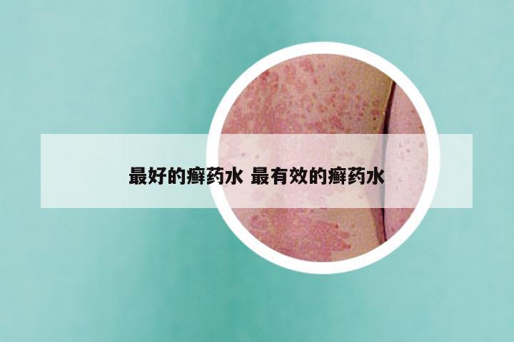 最好的癣药水 最有效的癣药水