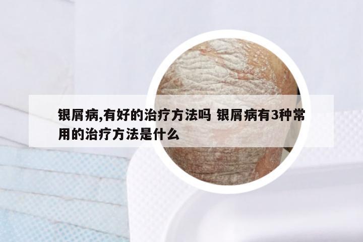 银屑病,有好的治疗方法吗 银屑病有3种常用的治疗方法是什么