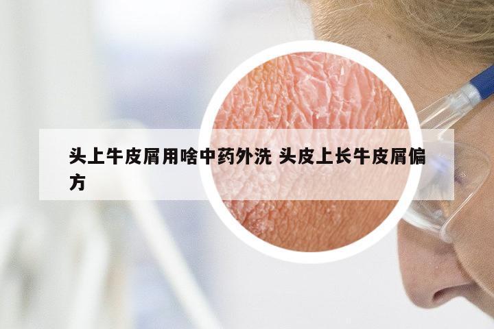头上牛皮屑用啥中药外洗 头皮上长牛皮屑偏方