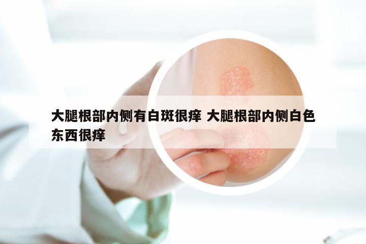 大腿根部内侧有白斑很痒 大腿根部内侧白色东西很痒