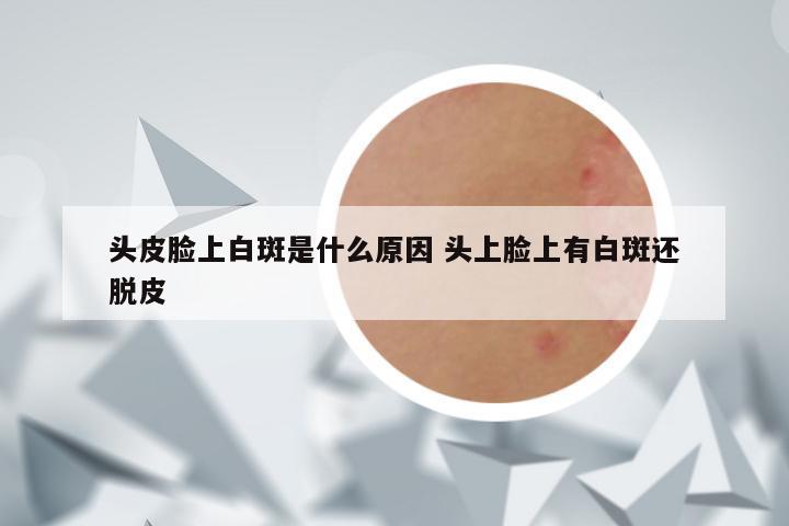 头皮脸上白斑是什么原因 头上脸上有白斑还脱皮