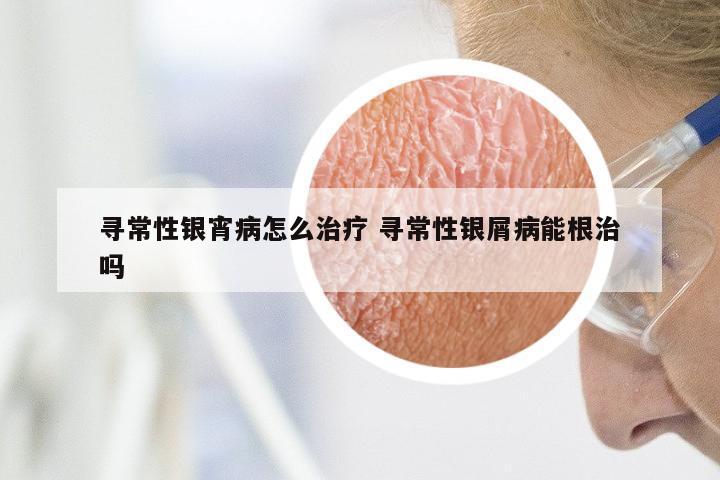寻常性银宵病怎么治疗 寻常性银屑病能根治吗