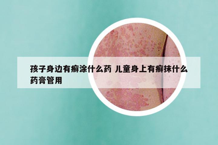 孩子身边有癣涂什么药 儿童身上有癣抹什么药膏管用