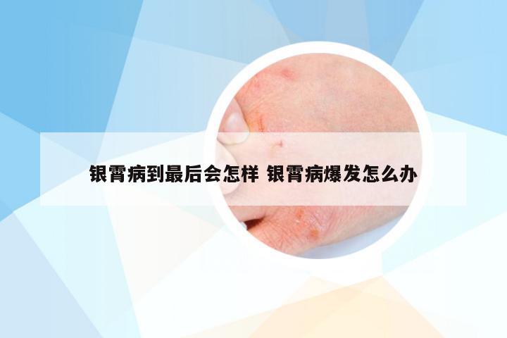 银霄病到最后会怎样 银霄病爆发怎么办