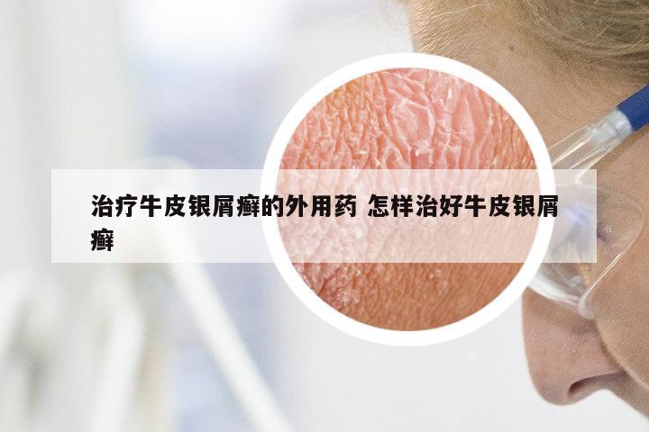 治疗牛皮银屑癣的外用药 怎样治好牛皮银屑癣