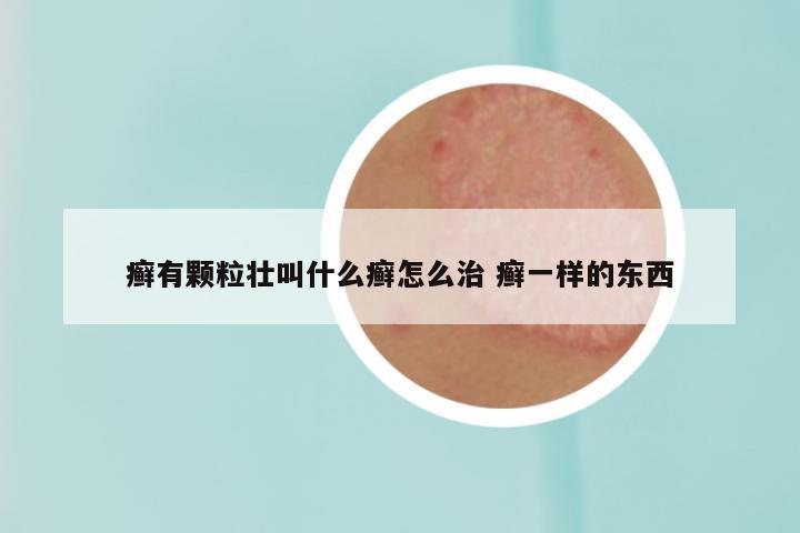 癣有颗粒壮叫什么癣怎么治 癣一样的东西
