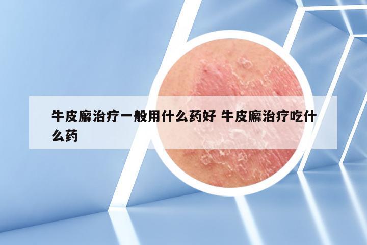 牛皮廨治疗一般用什么药好 牛皮廨治疗吃什么药