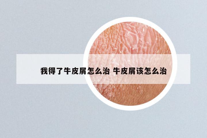 我得了牛皮屑怎么治 牛皮屑该怎么治