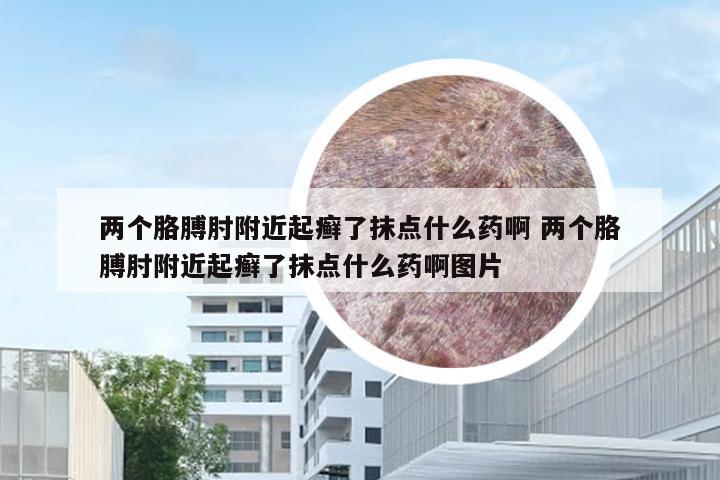两个胳膊肘附近起癣了抹点什么药啊 两个胳膊肘附近起癣了抹点什么药啊图片