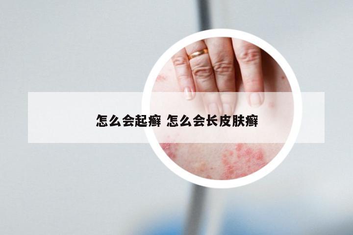 怎么会起癣 怎么会长皮肤癣