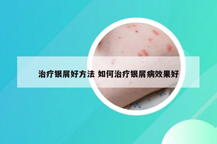 治疗银屑好方法 如何治疗银屑病效果好