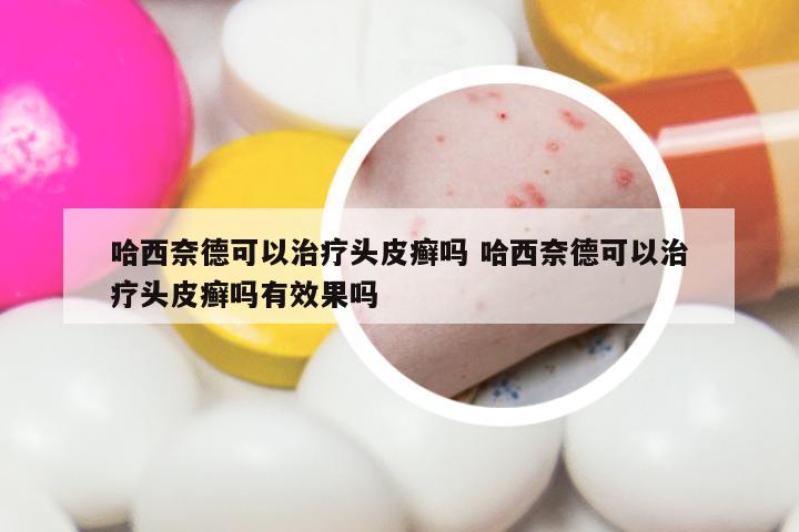 哈西奈德可以治疗头皮癣吗 哈西奈德可以治疗头皮癣吗有效果吗