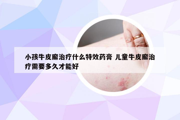 小孩牛皮廨治疗什么特效药膏 儿童牛皮廨治疗需要多久才能好