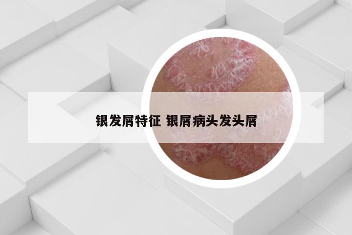 银发屑特征 银屑病头发头屑