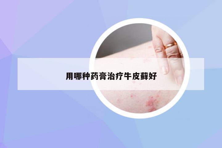 用哪种药膏治疗牛皮藓好