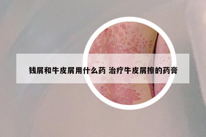 钱屑和牛皮屑用什么药 治疗牛皮屑擦的药膏