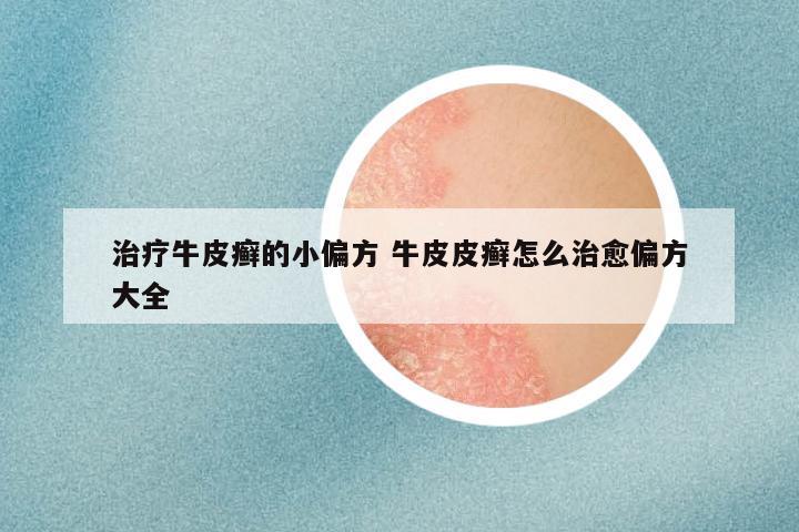 治疗牛皮癣的小偏方 牛皮皮癣怎么治愈偏方大全
