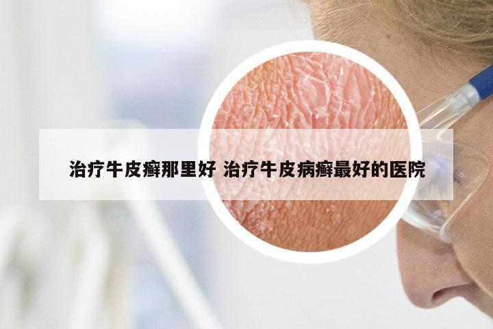 治疗牛皮癣那里好 治疗牛皮病癣最好的医院