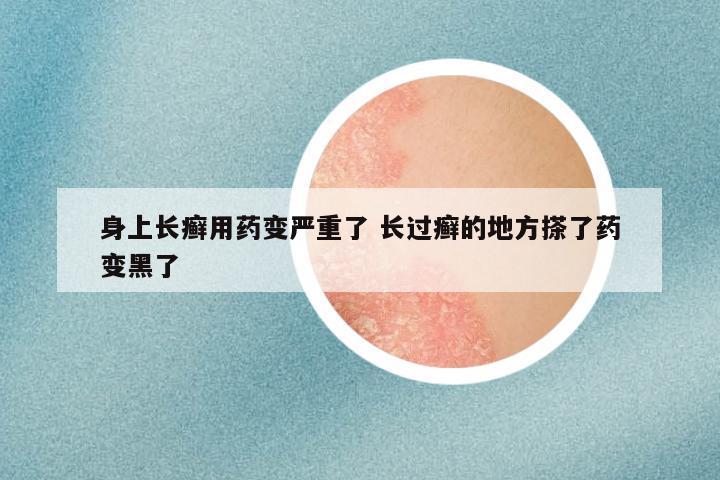 身上长癣用药变严重了 长过癣的地方搽了药变黑了