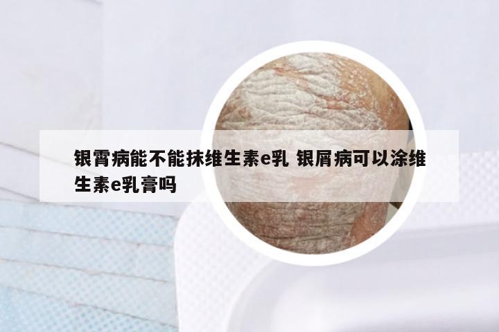 银霄病能不能抹维生素e乳 银屑病可以涂维生素e乳膏吗