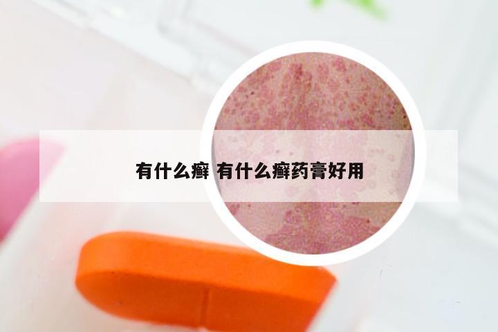 有什么癣 有什么癣药膏好用