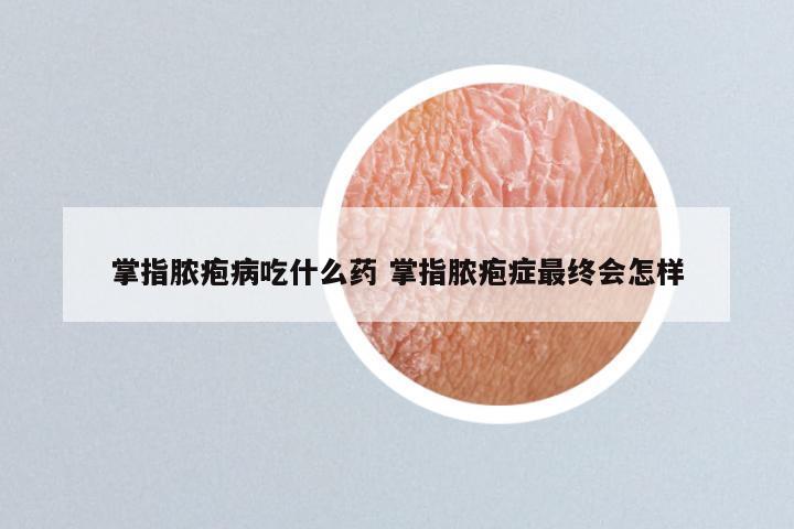 掌指脓疱病吃什么药 掌指脓疱症最终会怎样