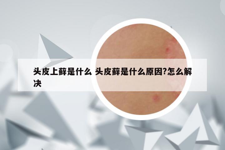 头皮上藓是什么 头皮藓是什么原因?怎么解决