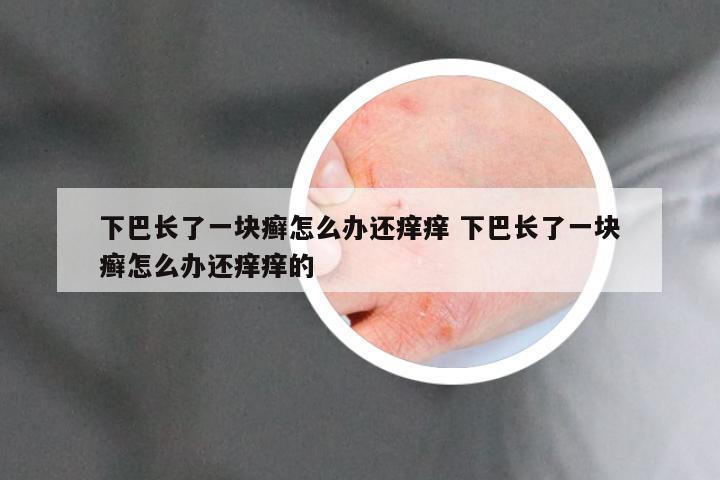 下巴长了一块癣怎么办还痒痒 下巴长了一块癣怎么办还痒痒的