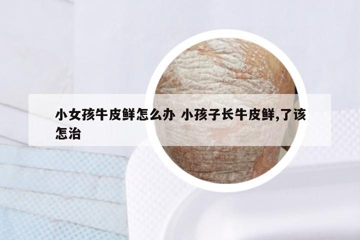 小女孩牛皮鲜怎么办 小孩子长牛皮鲜,了该怎治