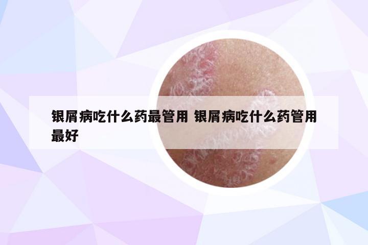 银屑病吃什么药最管用 银屑病吃什么药管用最好